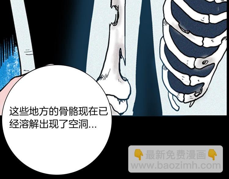 第63话 骨头溶解症（上）